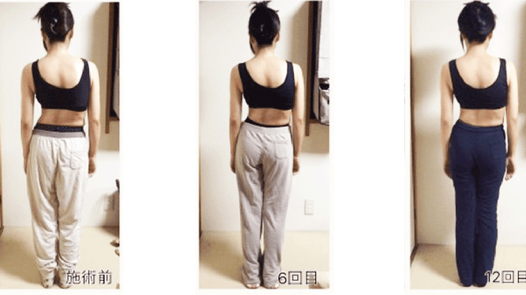側弯症の方の後ろから見た実際の写真