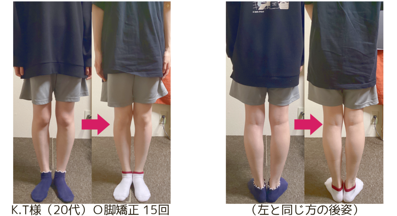 O脚の治し方|自分で改善できる?整体が必要なケースも解説