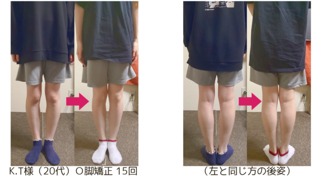 O脚の治し方｜自分で改善できる？整体が必要なケースも解説