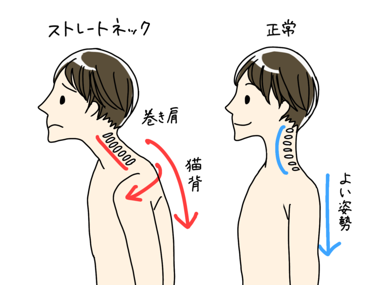 ストレートネック画像