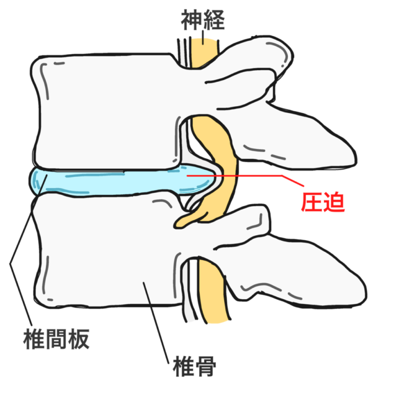 椎間板ヘルニアのイメージ