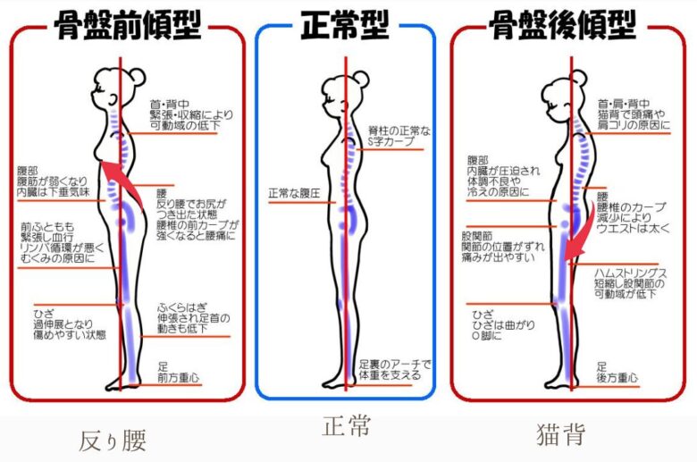 反り腰・正常・猫背の姿勢特徴の説明画像