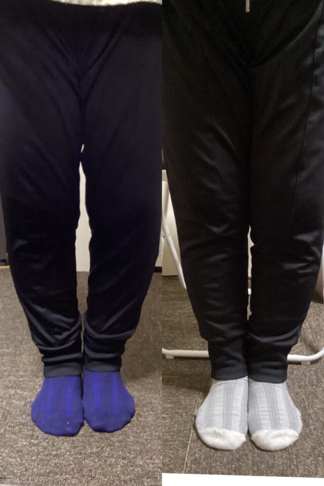 手術後も膝が痛い方へ｜10年以上続いた変形性膝関節症の経過