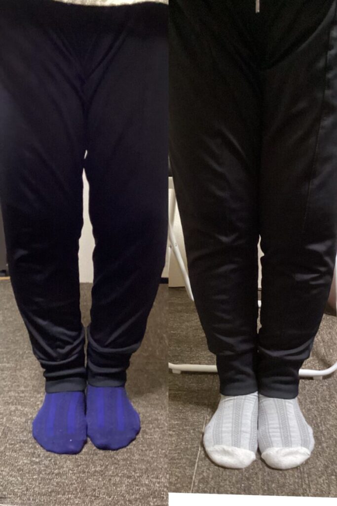 変形性膝関節症の方のO脚