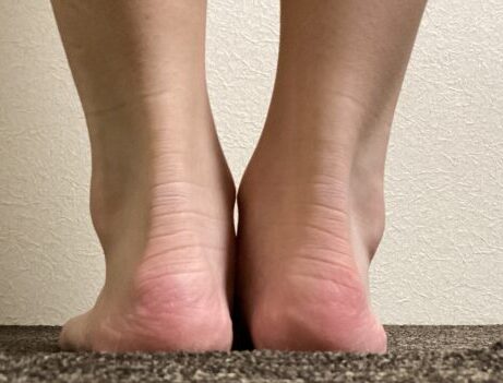 O脚でご来店のお客様の足首