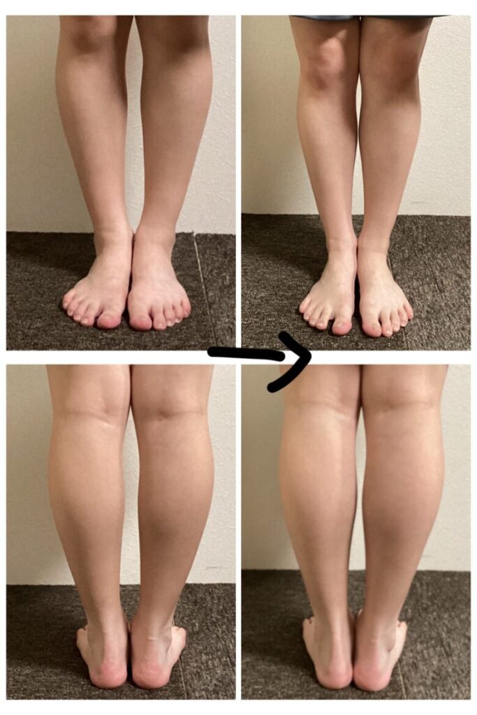 O脚の変化